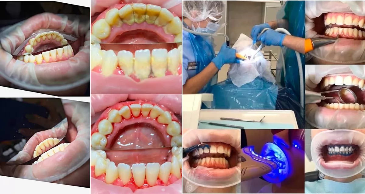 лечение зубов по купону