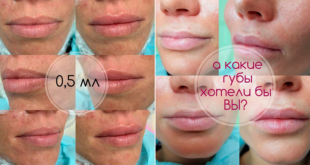 коррекция формы лица
