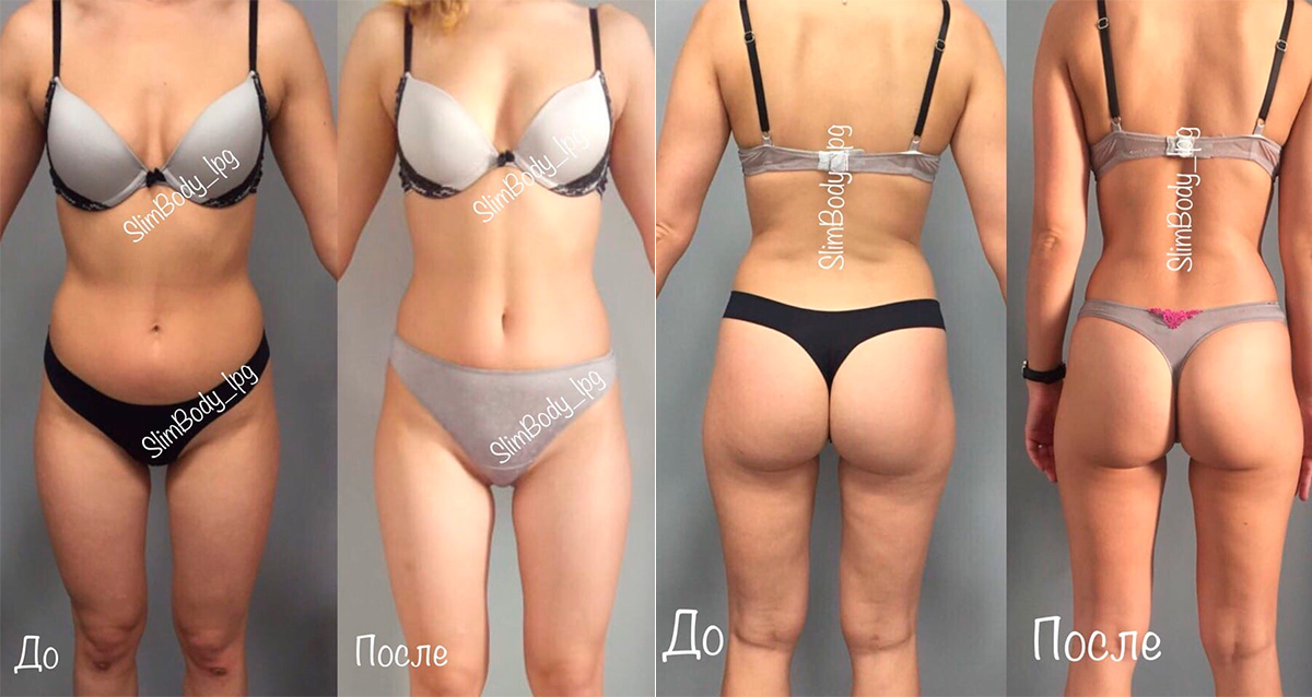 результаты лпг массажа